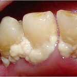Heavy dental plaque