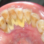 regular dental checkup to avoid tooth tartar