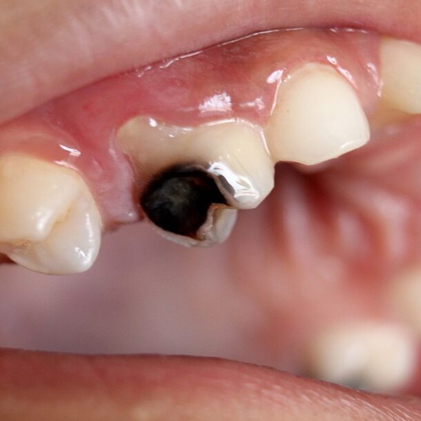 rotten teeth in children