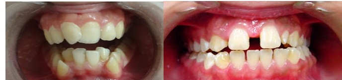 Mal-aligned teeth in children