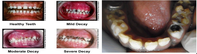 Tooth decay in children