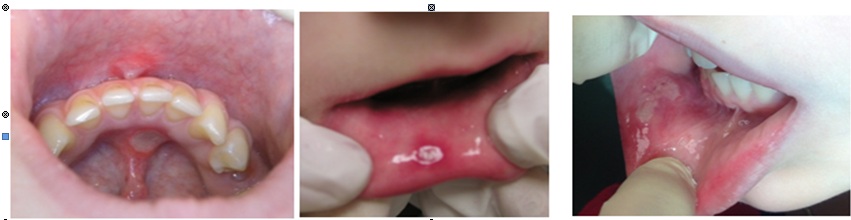 Ulceration in Children