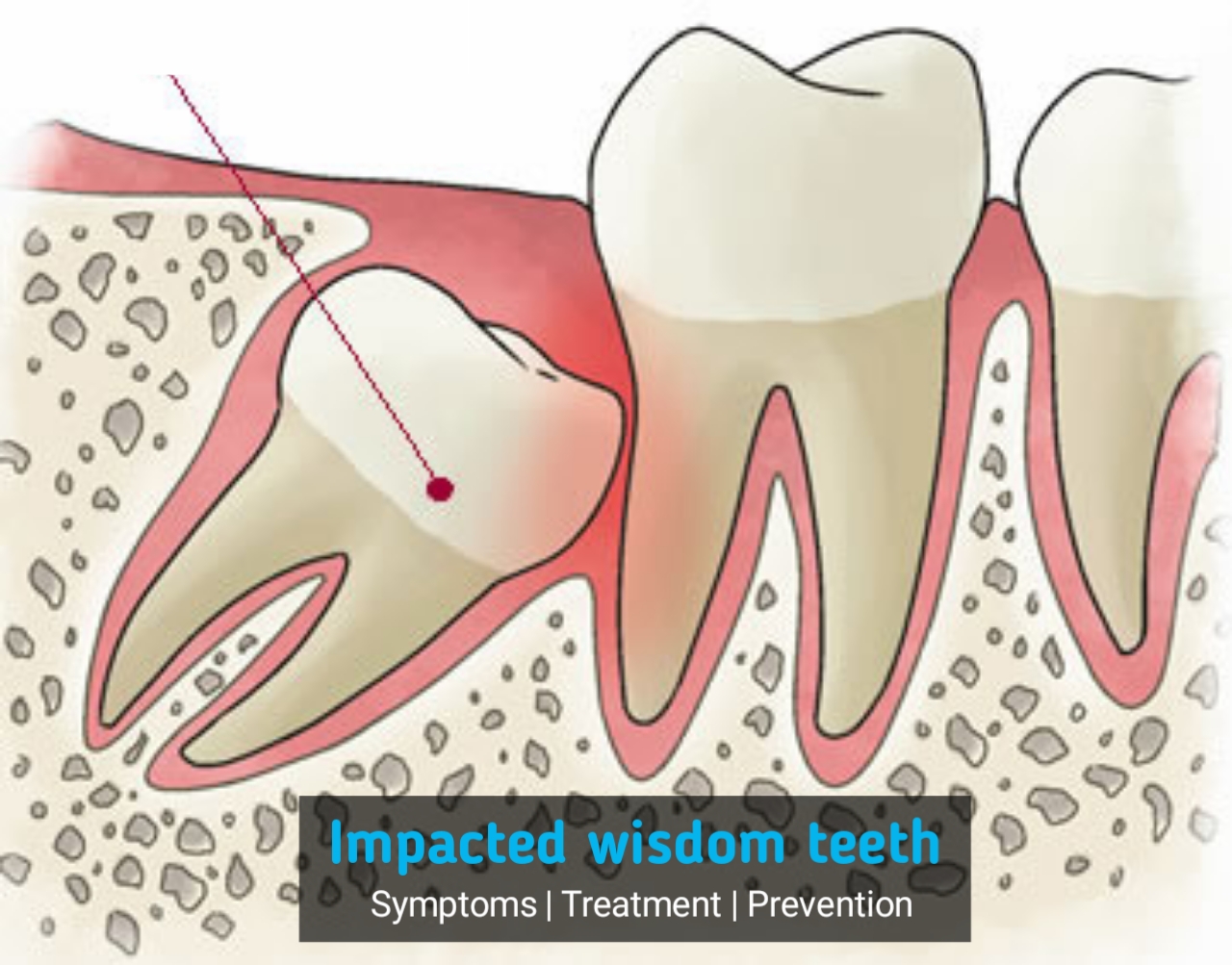 Impacted Wisdom teeth