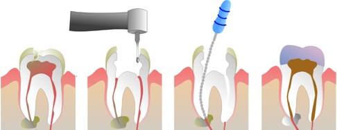 Root Canal treatment procedure
