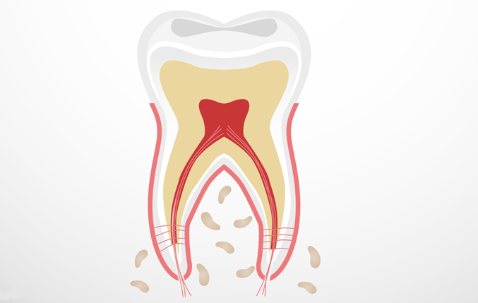 treatment for tooth sensitivity