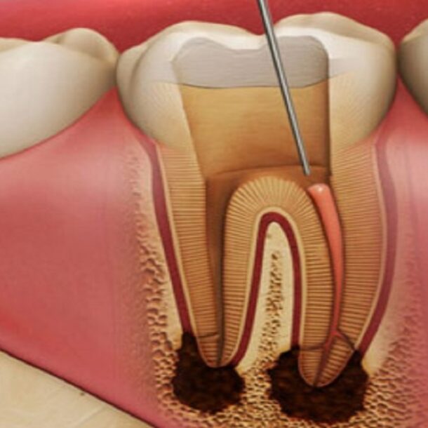 root canal treatment pune