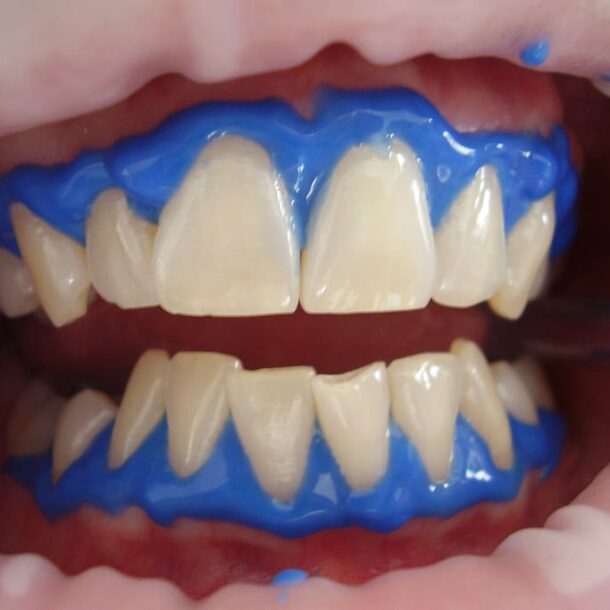 Teeth Whitening pune
