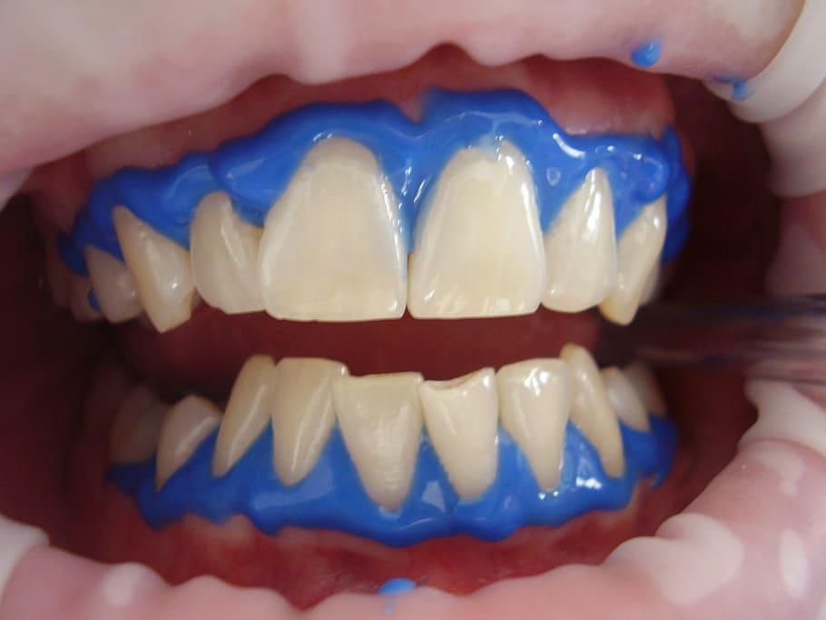 Teeth Whitening pune