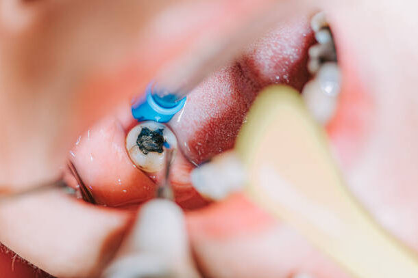 Root Canal Treatment in Pune