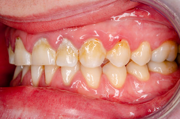 Dental Plaque