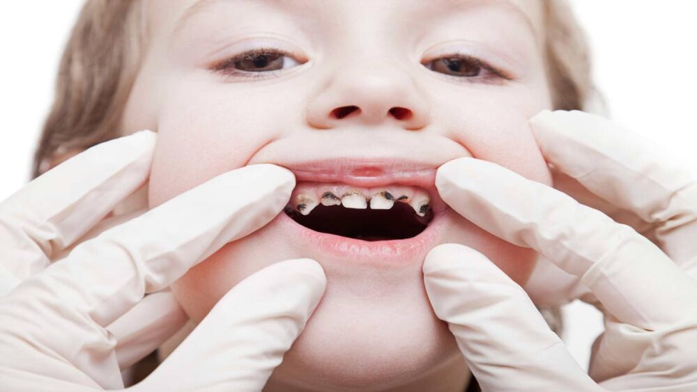 Rotten Teeth In Children