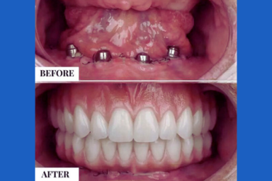 Full Mouth Dental Implant