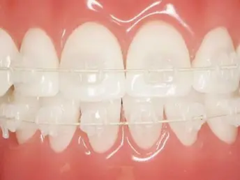 Ceramic Braces