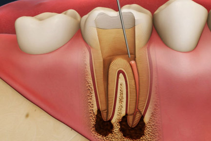 Root Canal Treatment