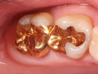 gold filling