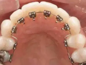 lingual braces