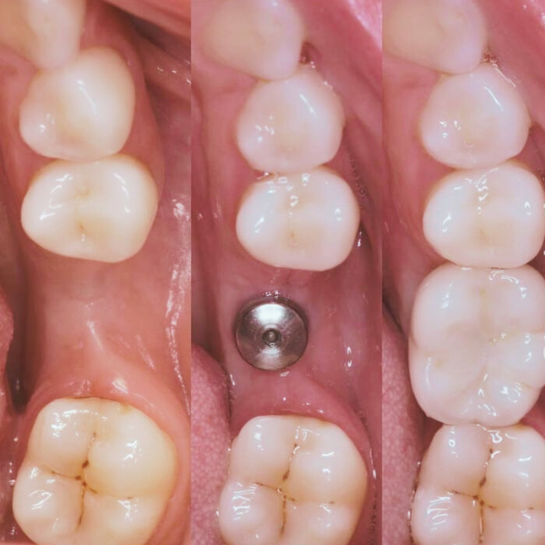 Dental Implant Pune