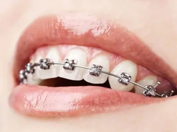 Metal Braces