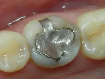 silver filling